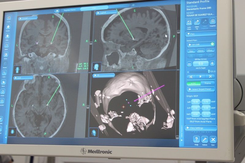 Electrodos implantados vistos en neronavegador