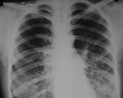 Tétano generalizado