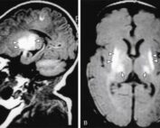 Encefalopatía Hipóxico-Isquémica